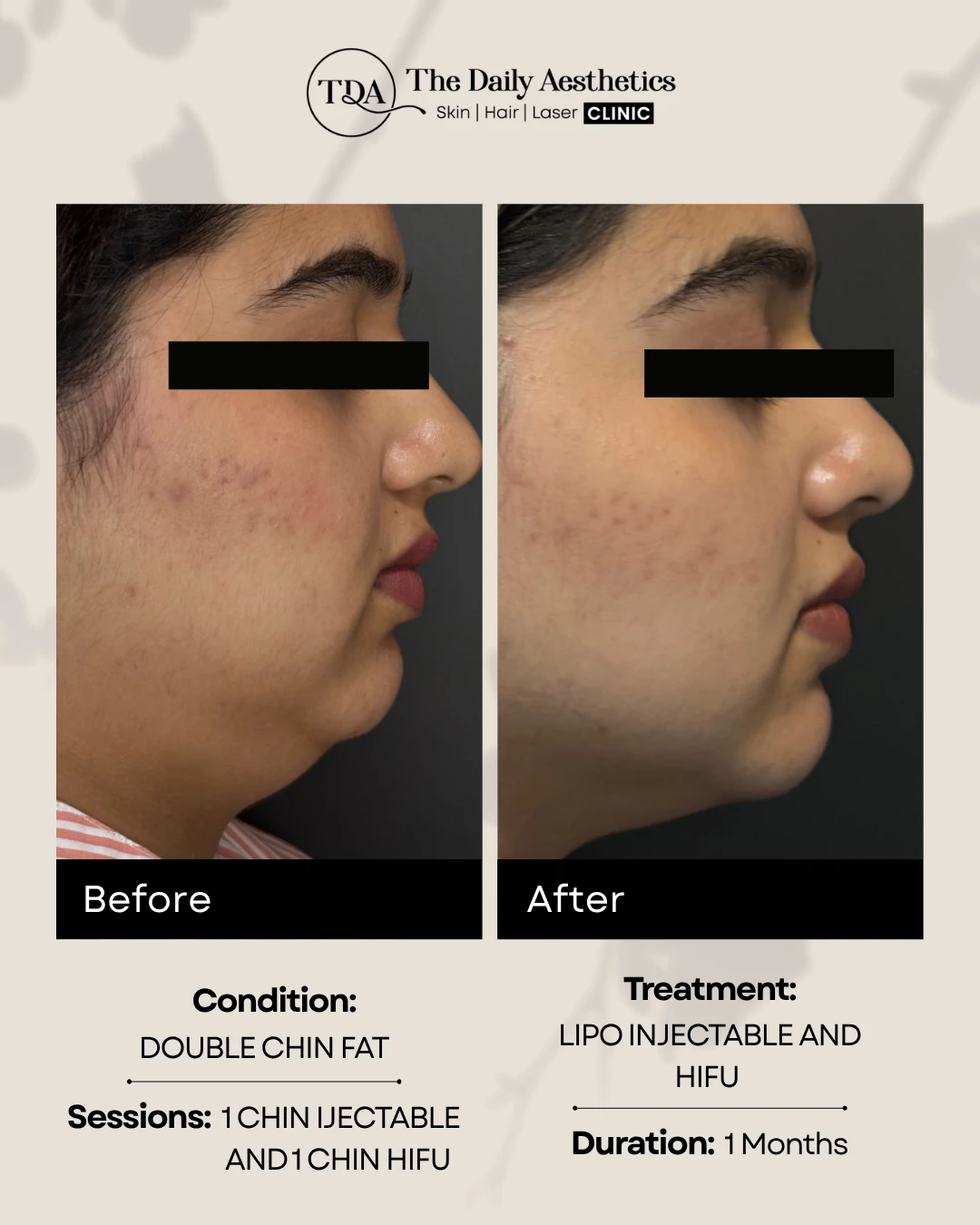 Lip Injectable and HIFU (Double Chin Fat)