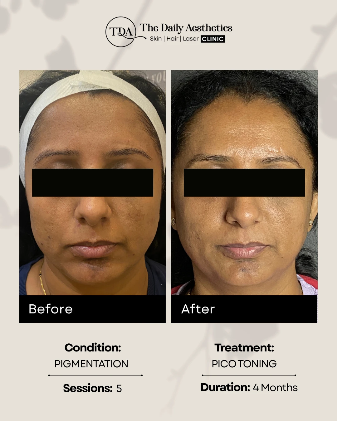 Pico Tonning (Pigmentation)