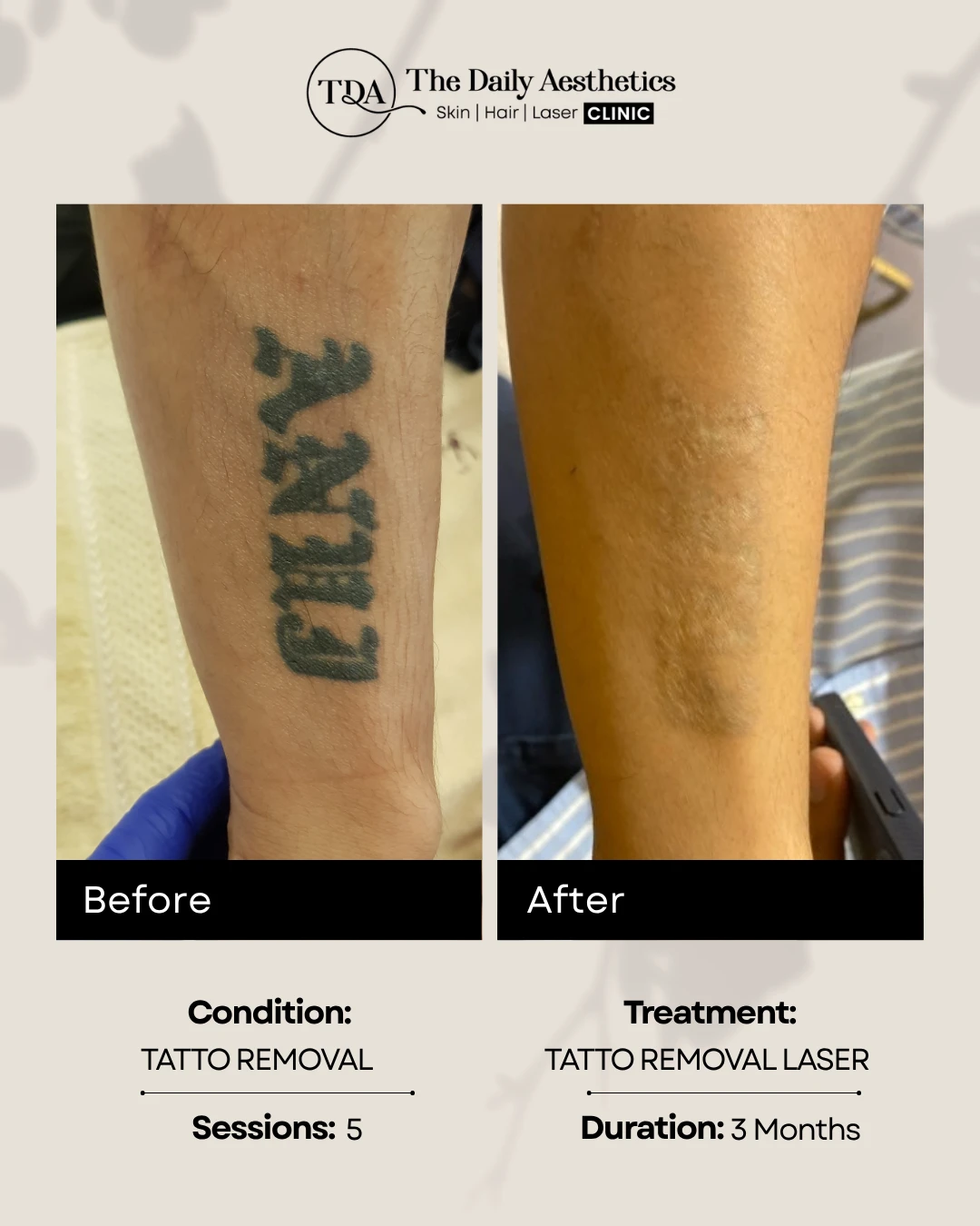 Tatto Removal Laser (Tatto Removal) (2)