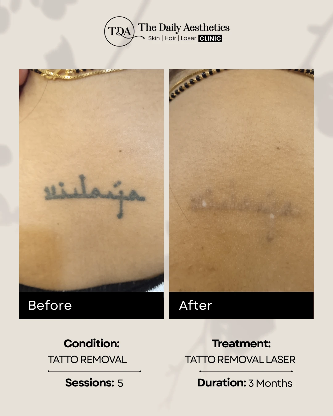Tatto Removal Laser (Tatto Removal)