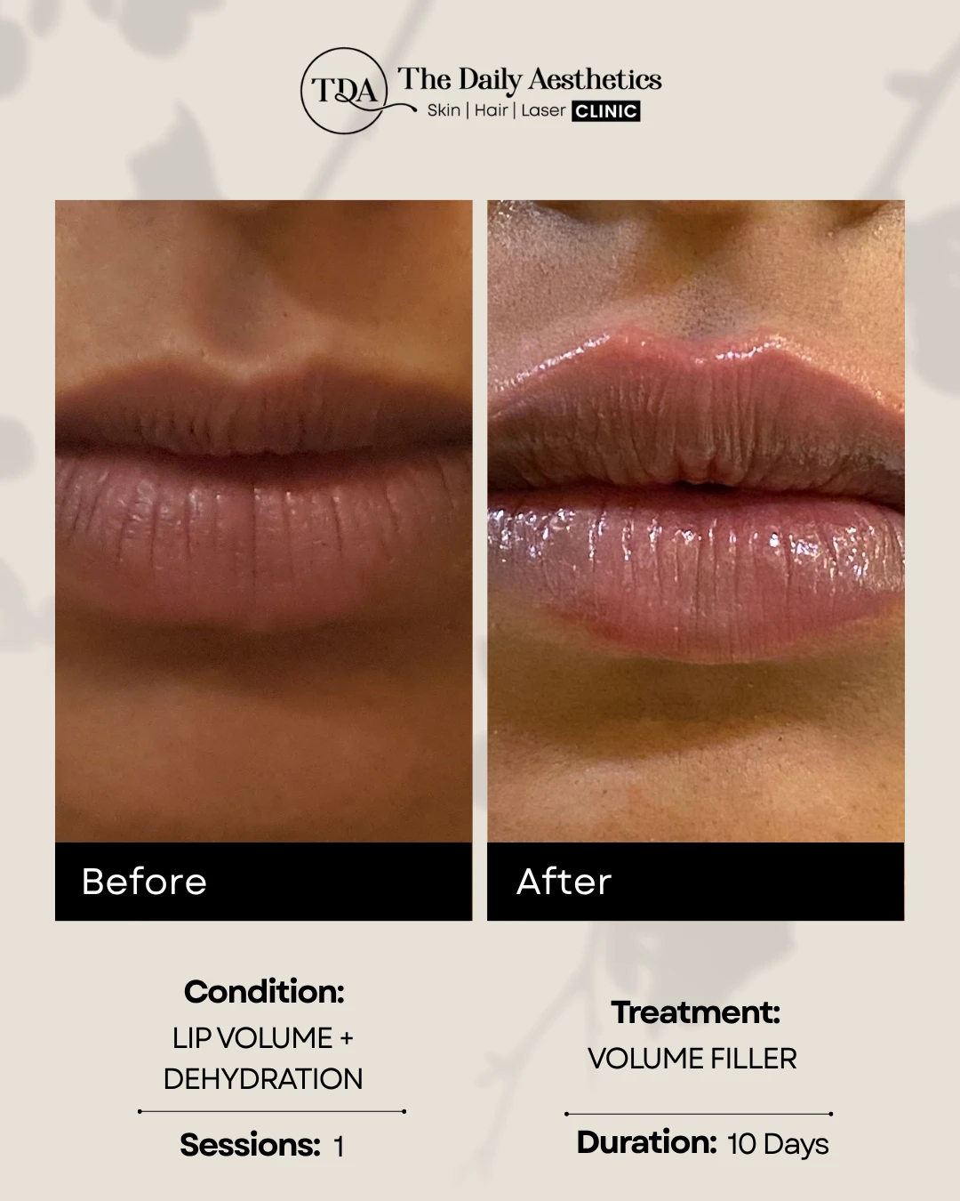 Volume Filler (Lip Volume + Dehydration)