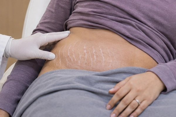 Striae Albae (White or Mature Stretch Marks)