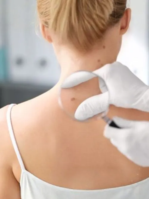 Skin Tag Removal