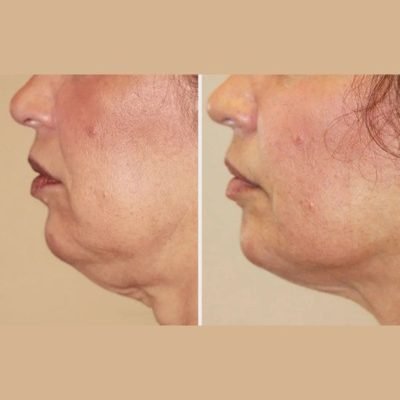 Skin Tightening in Pune Skin Tightening